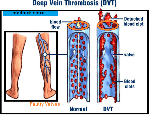 Symptoms of Venous Insufficiency, medteck.store